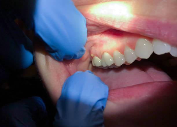 Best Emergency Broken Tooth Repair in South Lebanon, OH